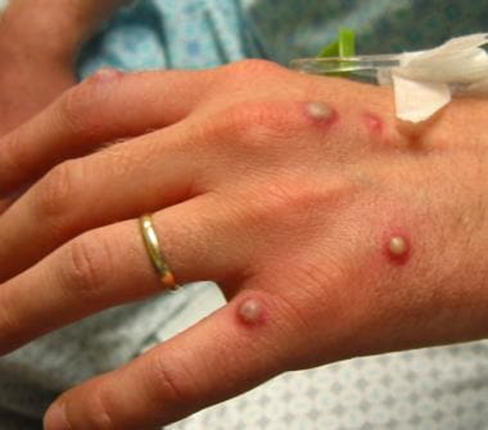 Monkeypox: How Can You Catch It And What Are The Symptoms?