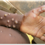 Monkeypox: How Can You Catch It And What Are The Symptoms?