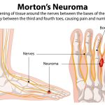 Mortons Neuroma