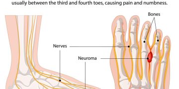 Mortons Neuroma