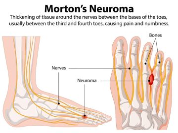 Mortons Neuroma