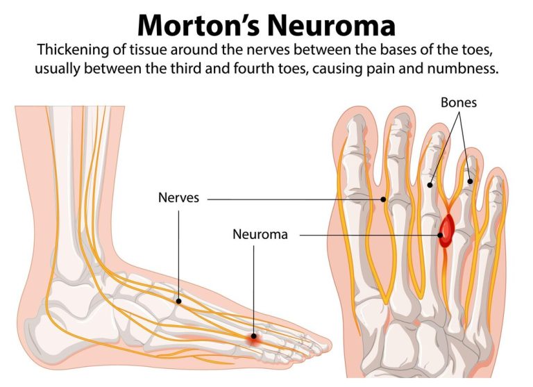 Mortons Neuroma